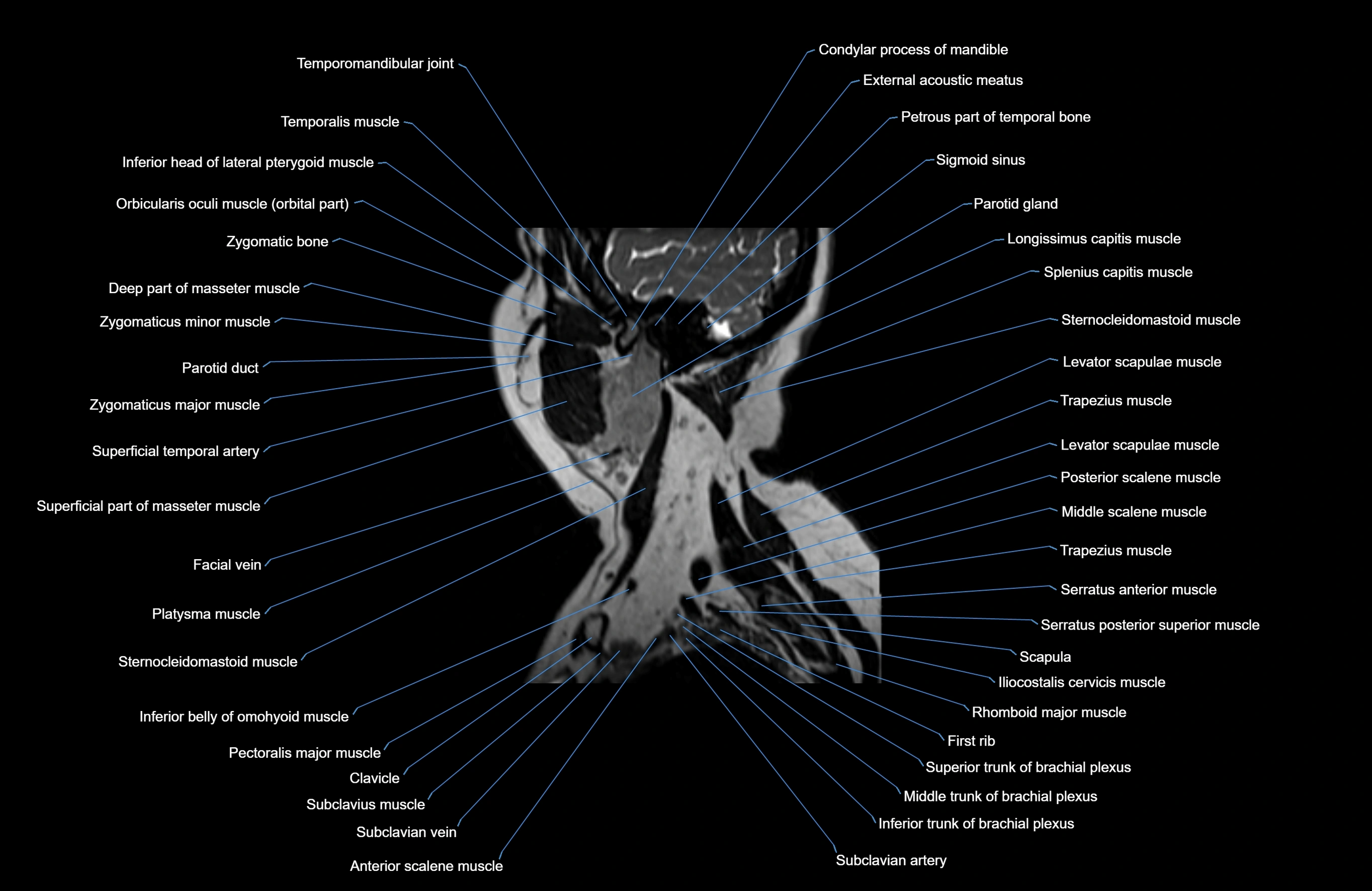 Neck MRI sagittal cross sectional anatomy 3D 1mm 3T radiology  image-img-00001-00032.webp